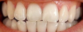 whiten human teeth